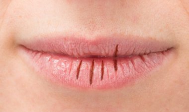 सर्दियों में फटे होंठों से न हों परेशान, ये 5 देसी नुस्खे दिलाएंगे दर्द से राहत, लौट आएगी मुस्कान