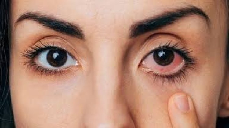 मानसून में तेजी से बढ़ रहा आई फ्लू (Eye Flu) का खतरा: जानें कंजंक्टिवाइटिस के लक्षण और बचाव के आसान उपाय